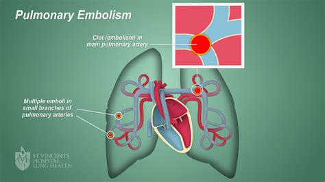 embolism pulmonary